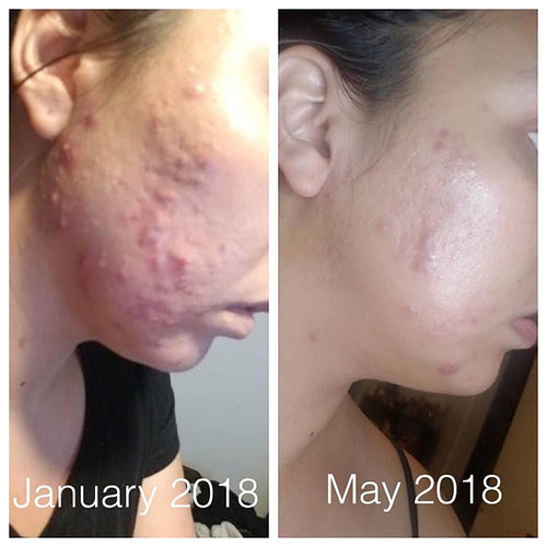 Clear Skin Collection
